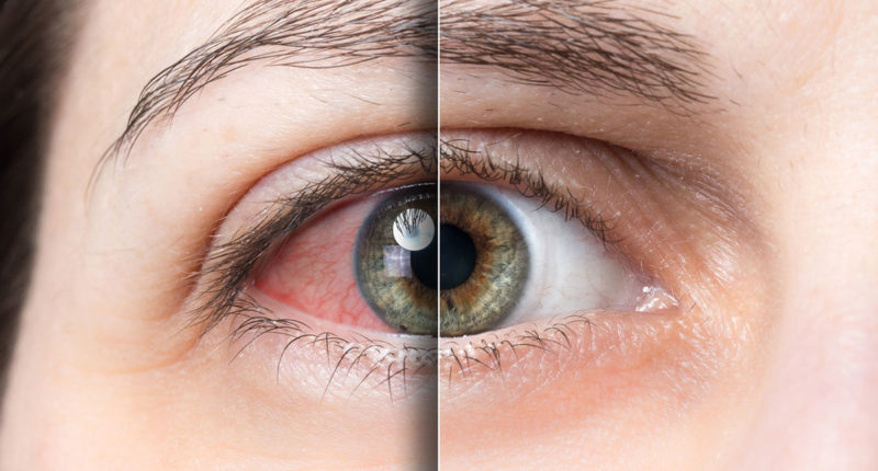 Síndrome do olho seco: Como tratar?