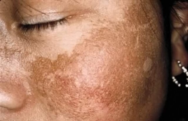 Como amenizar manchas e melasma?