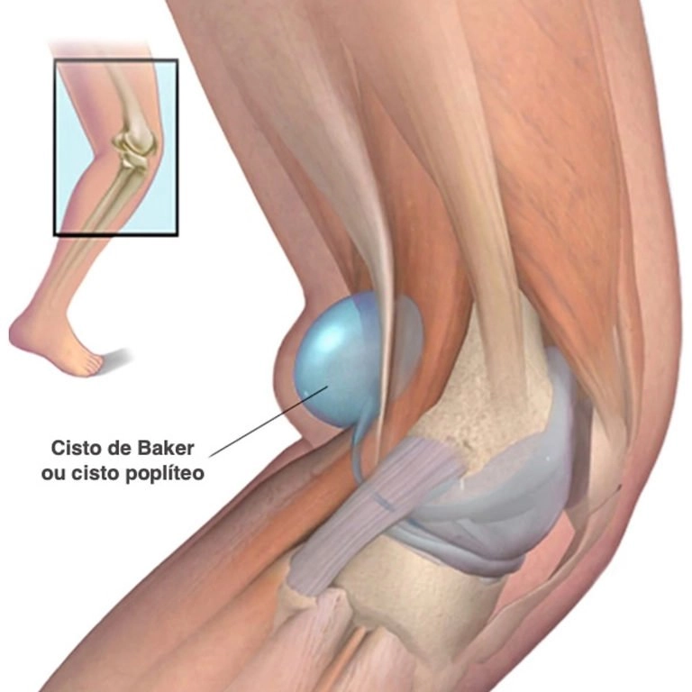 Dor atrás do joelho – conheça o cisto de baker