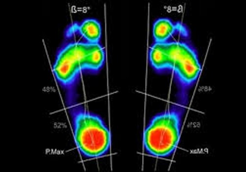 Baropodometria – Descubra o seu tipo de pisada