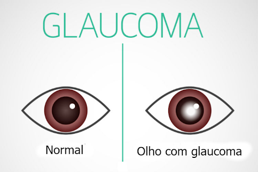 Como prevenir GLAUCOMA