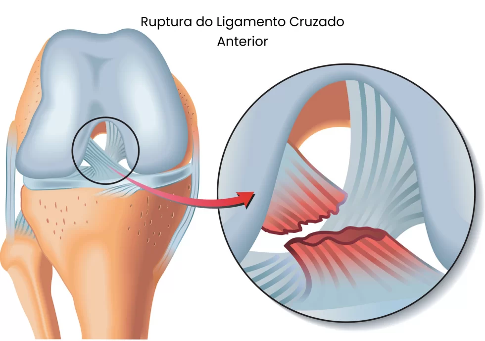 Ruptura de ligamento tem tratamento?